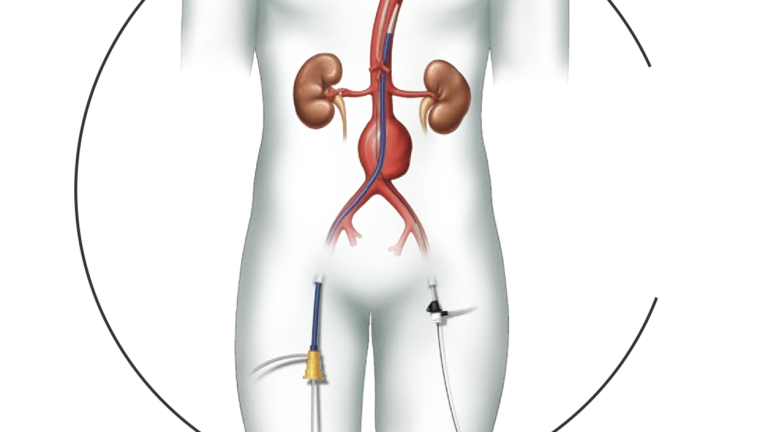 Endovascular Repair Graphic