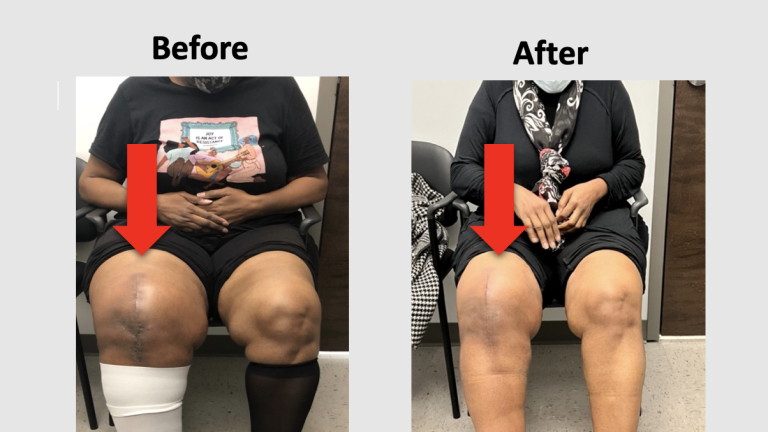 Before and After Clot Removal and Vein Stenting in the Hospital