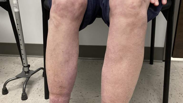 Left Leg After Clot Removal at AccessCare