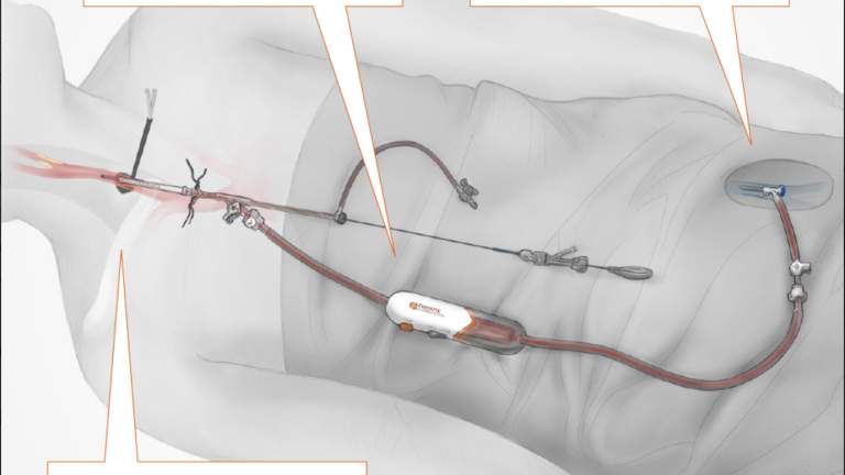 Flow Reversal System