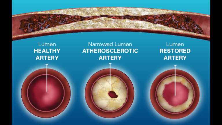Healthy, Diseased, and Post Treatment Arteries