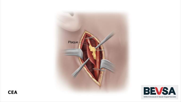 Carotid Endarterectomy Graphic