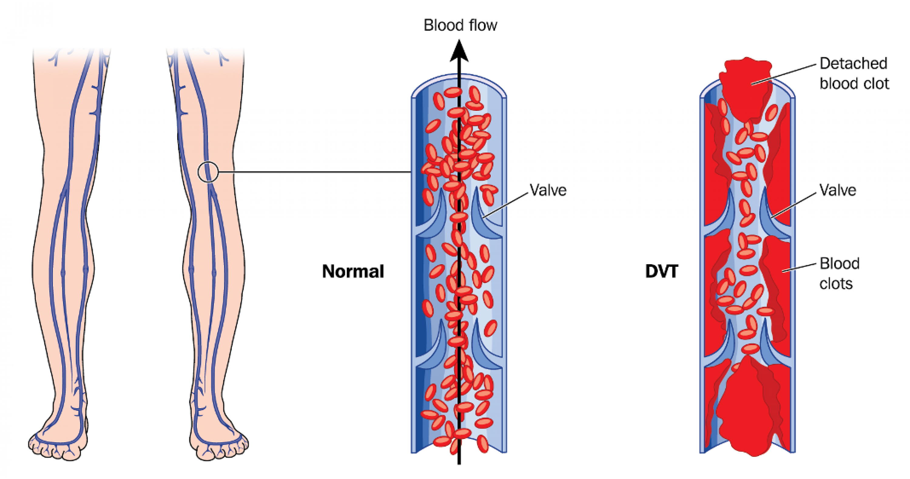 blood clot in back of knee